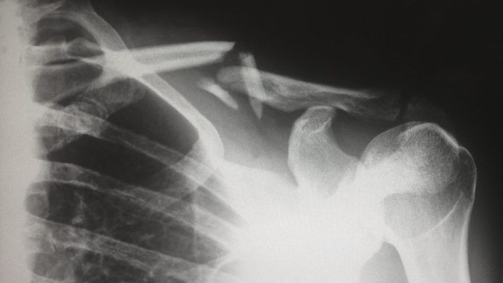 black and white x ray of a broken human clavicle