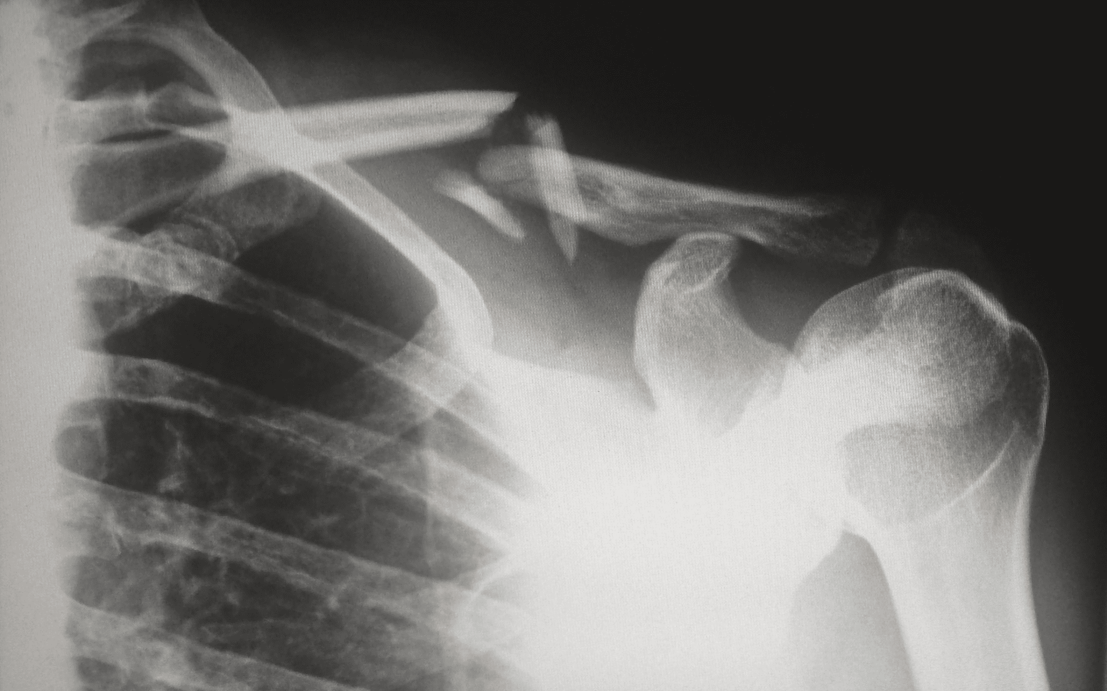 grayscale x-ray of shoulder bones