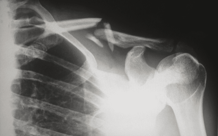 grayscale x-ray of shoulder bones